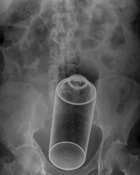 Resultado de imagen para radiografias de objetos intestinos