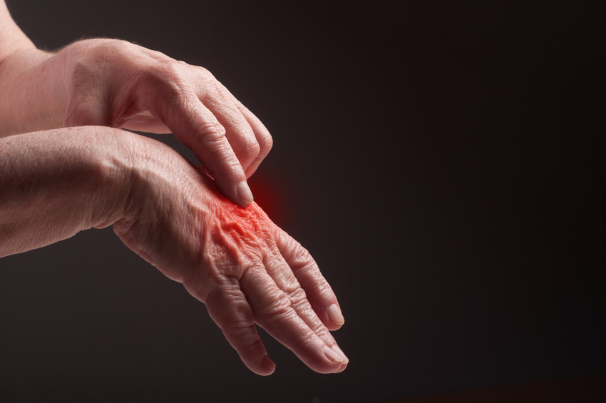 Vivir sin dolor es posible para pacientes con artritis reumatoidea: cuándo consultar