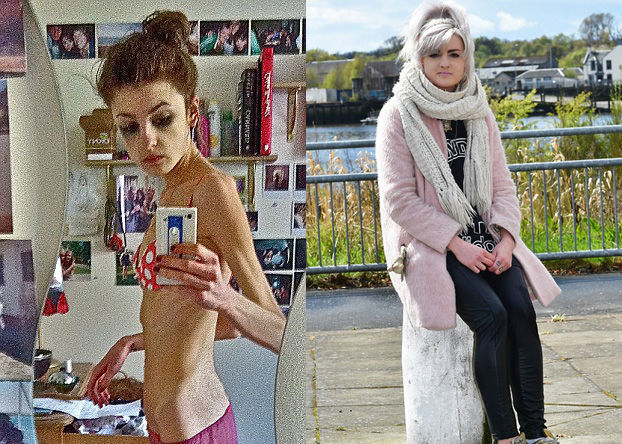 Joven recuperada de anorexia intenta ayudar a otros con su testimonio