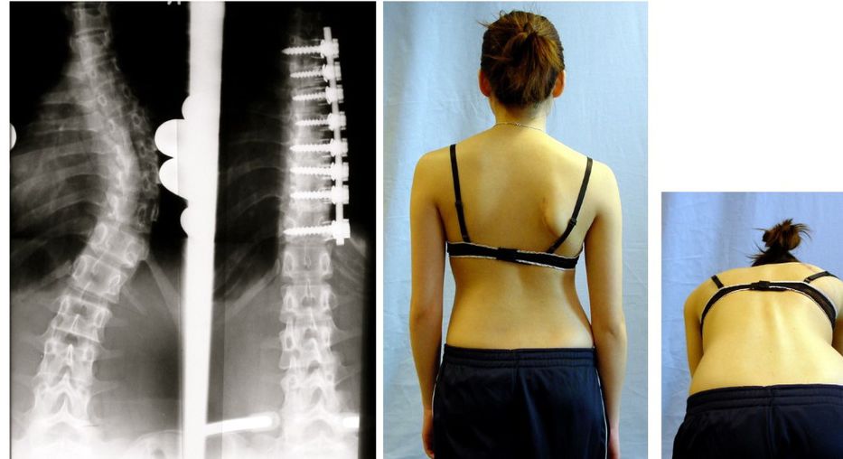 Genes adolescentes mutantes