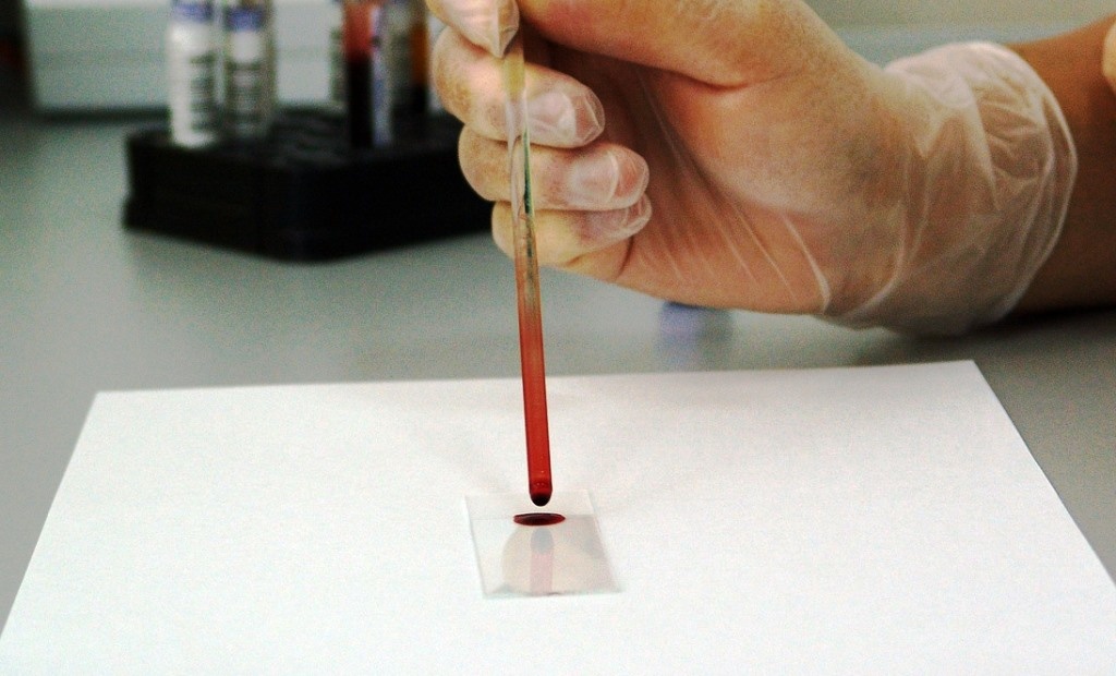 Un nuevo análisis de sangre detecta mejor el cáncer de próstata agresivo, según un estudio