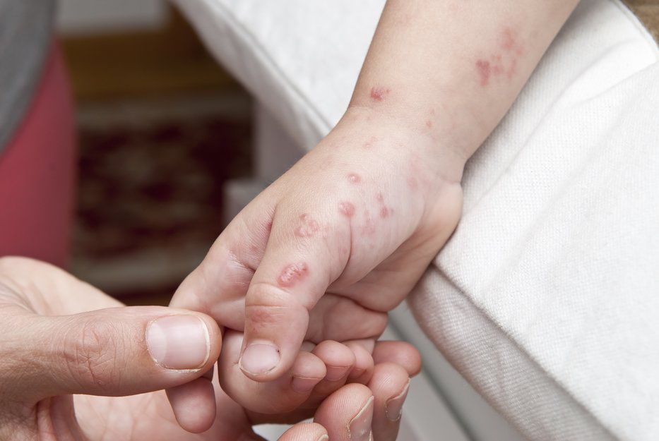 Alerta en el Bauzá: Aumento de casos de varicela preocupa a las autoridades sanitarias y se esperan más contagios