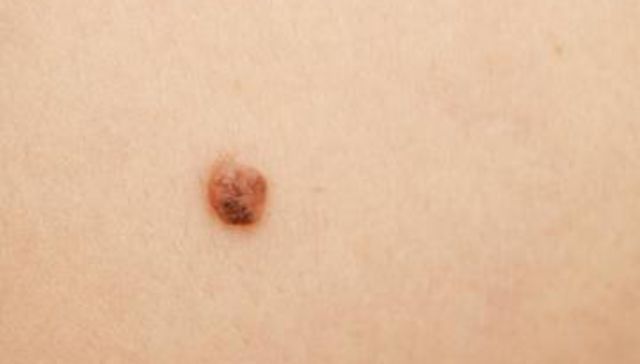 Una cuestión de piel