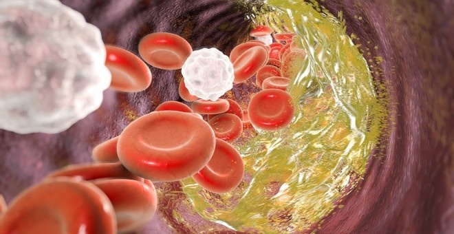 Estudio revela cambios en presión arterial y colesterol en personas con obesidad