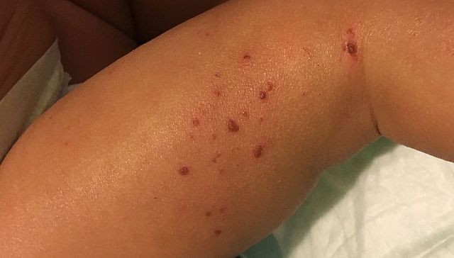 Una cuestión de piel