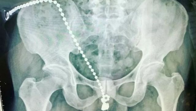 Se fue el balde. . .