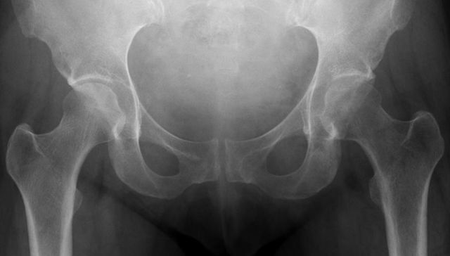 Día Mundial de la Osteoporosis