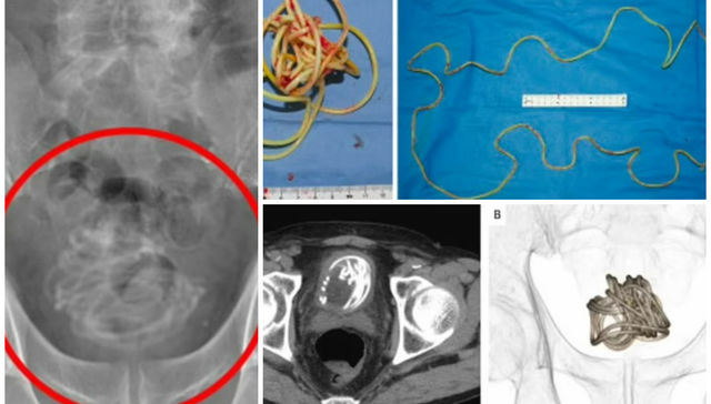 Qué vejiga más grande