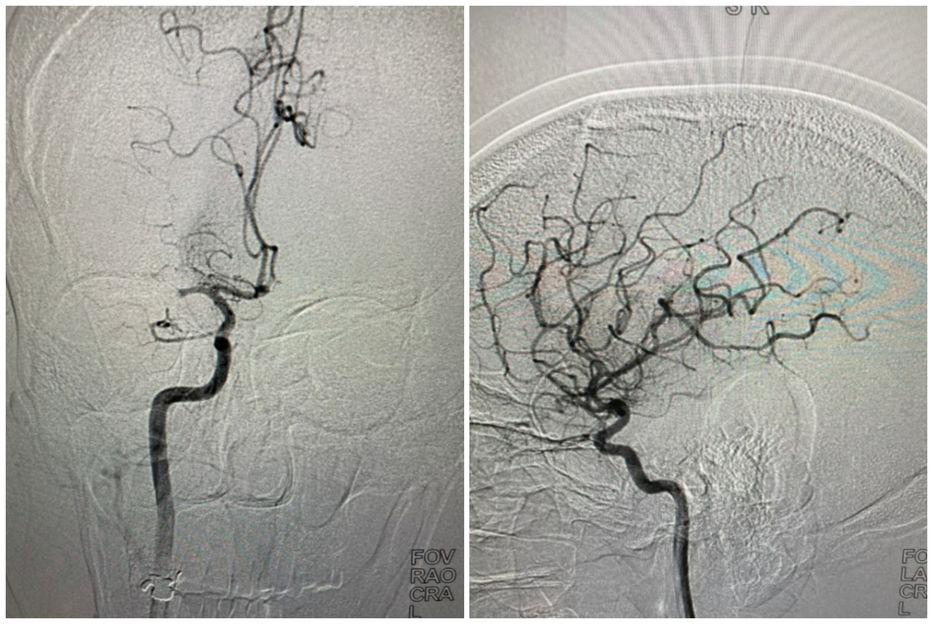 La arteria antes y después de la remoción del trombo