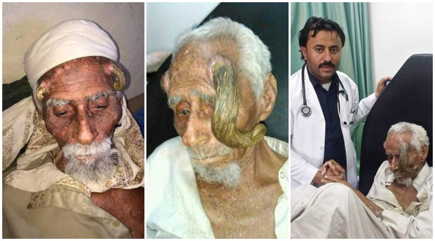 Hombre que decía ser el más viejo del mundo murió tras fallida “extracción de cuerno”
