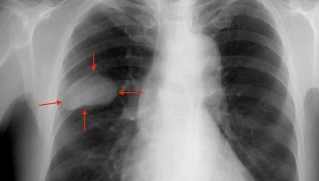Negligencia absoluta
