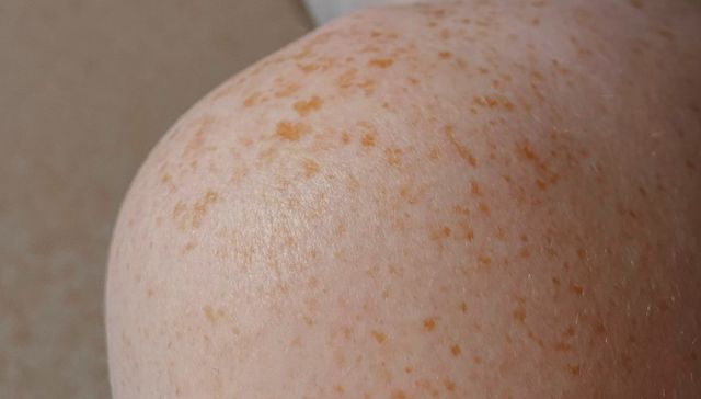 Una cuestión de piel