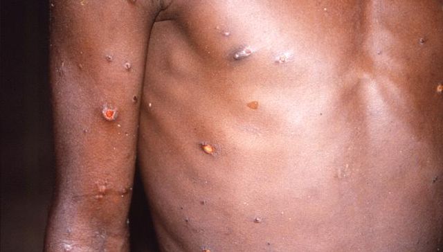 Epidemia