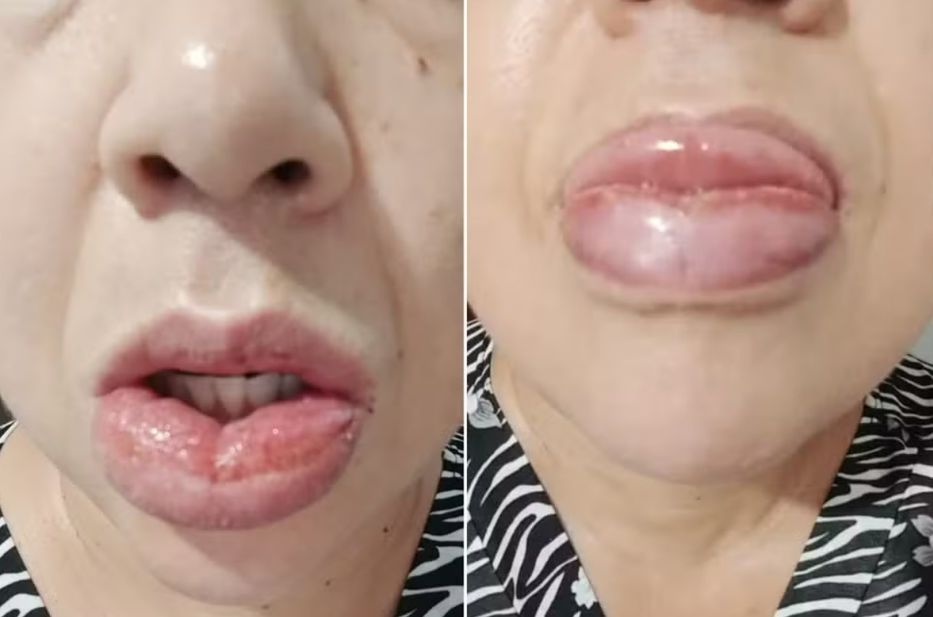 Imagen aportada por una educadora social de 45 años, residente en San Pablo, quien manifestó haber sufrido una reacción alérgica tras usar el producto. Archivo personal