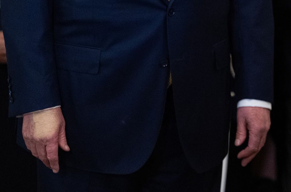 Hematoma en la mano de Donald Trump. Foto: AFP.