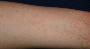 Una cuestión de piel