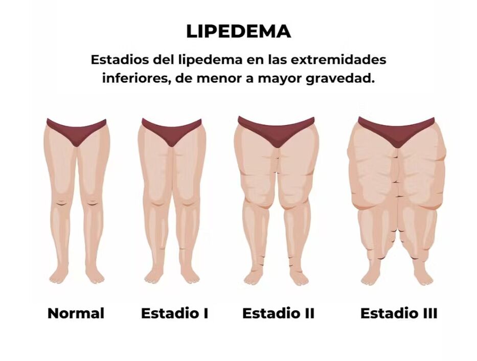 Lipedema