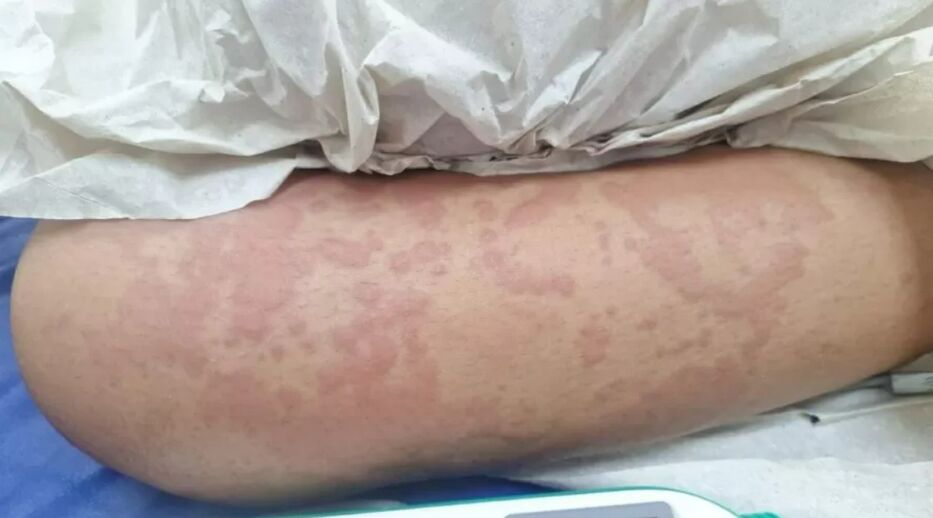 Brasil: niña es internada tras usar detergente prohibido y autoridades reafirman decisión