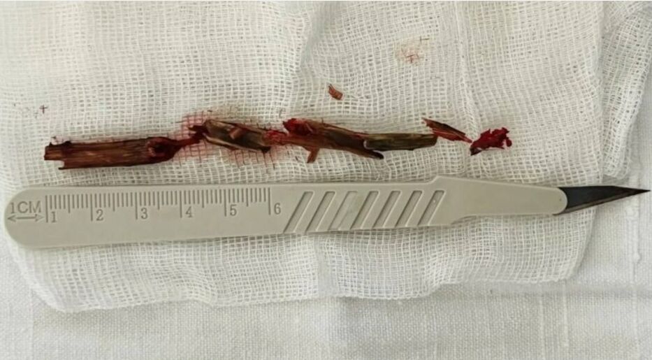 Casi queda tuerto: vivió un año y medio con una astilla de 12 cm en el ojo y sin saberlo