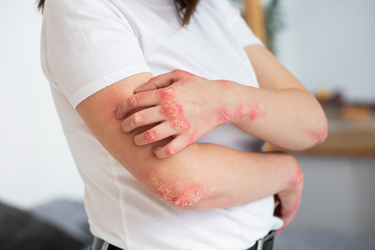 Psoriasis: los mitos que mantienen el estigma y los riesgos de no tener diagnóstico