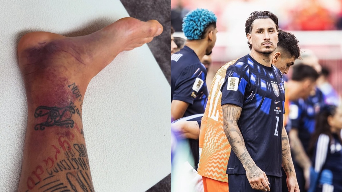 Josema Giménez mostró su tobillo destrozado, pero aclaró: “Apto desde el primer partido”