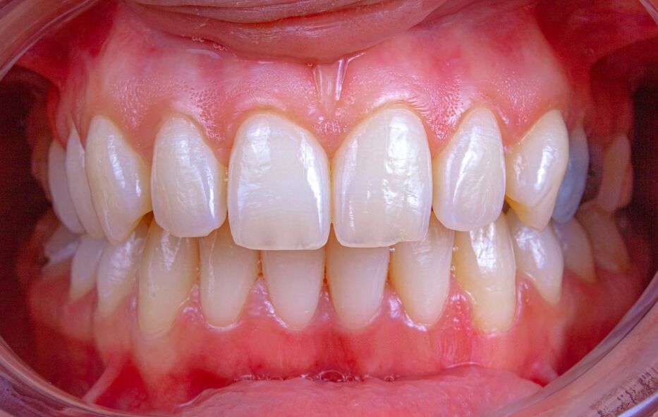 ¿Chau a las caries? Crearon un gel que podría regenerar el esmalte dental