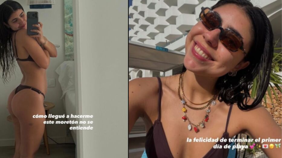 Microbikini y un percance: Cami Mayan mostró su look y un gran moretón