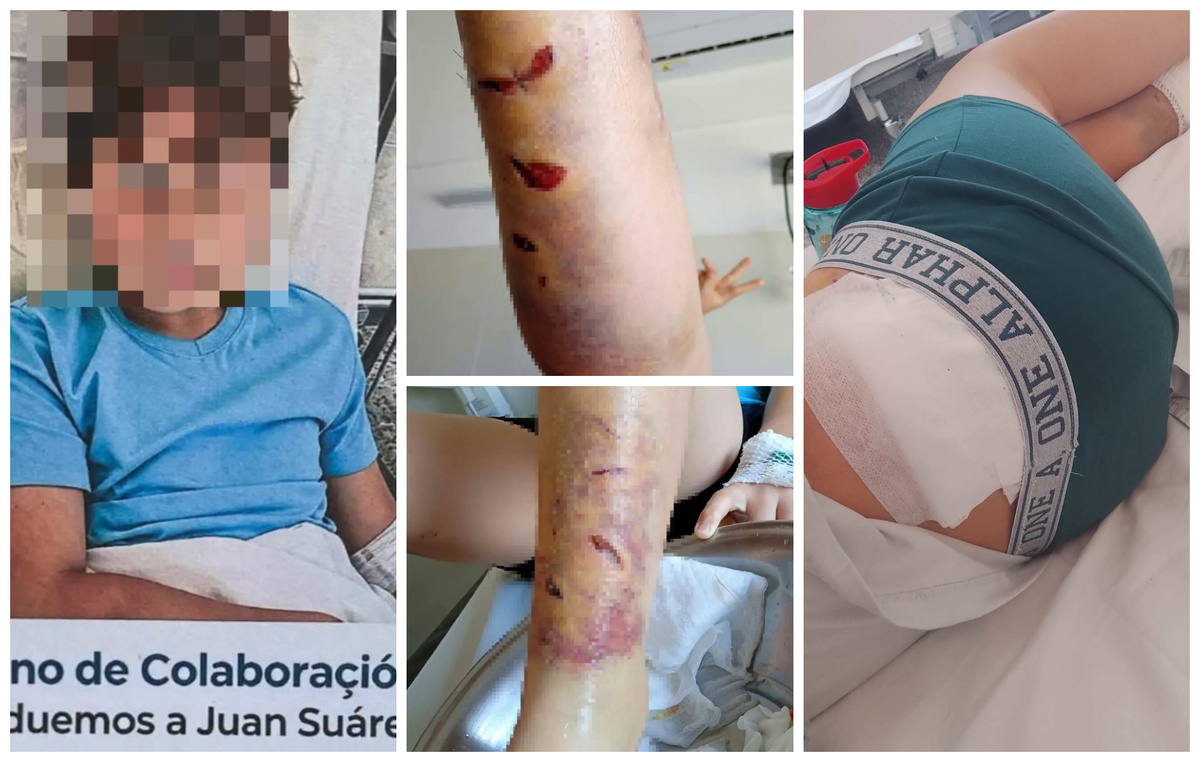 Tremendo: niño fue atacado por varios perros y su familia pide ayuda para su recuperación