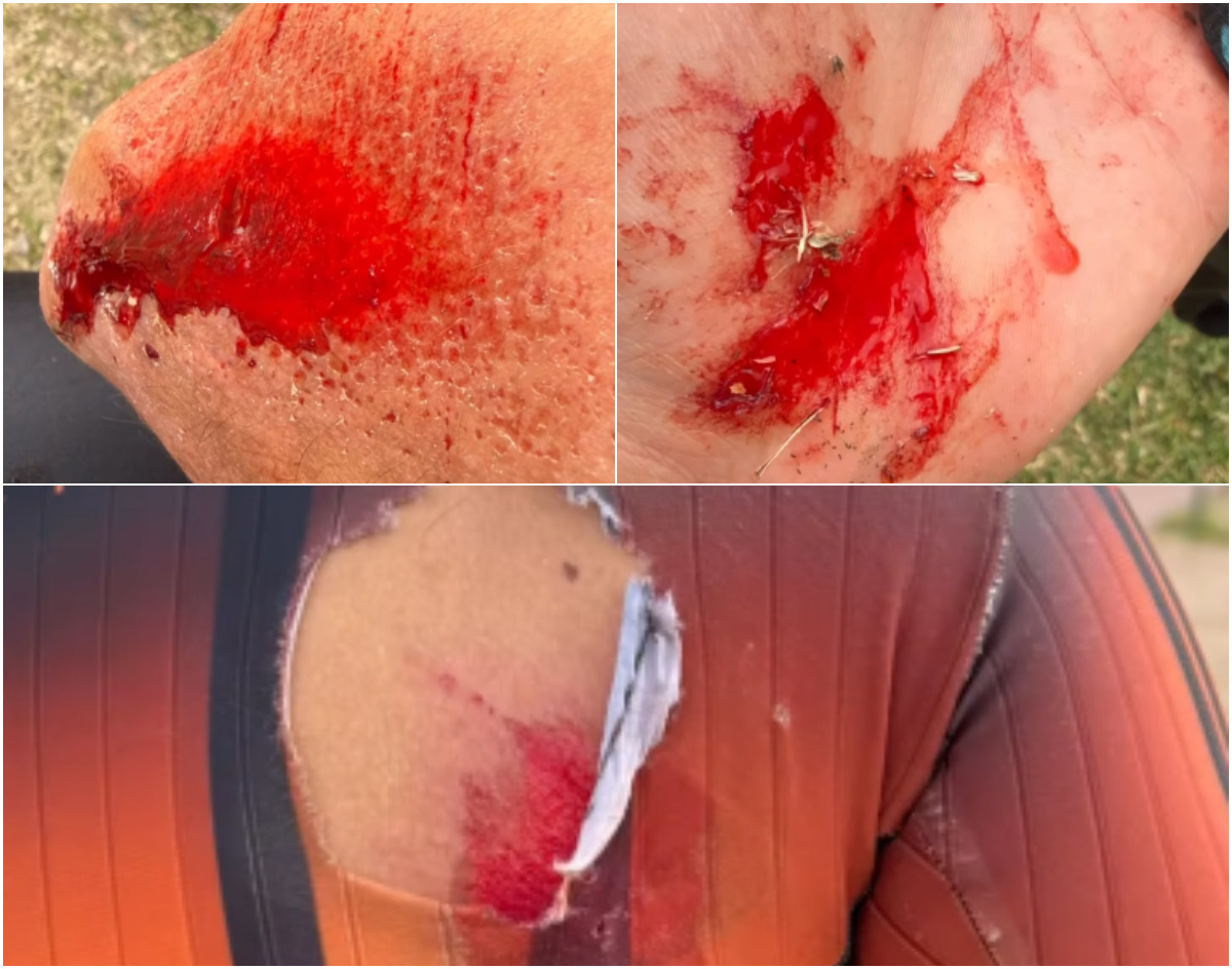 Patinador escrachó a agresor de Ciudad de la Costa que lo hizo “volar” y mostró cómo quedó